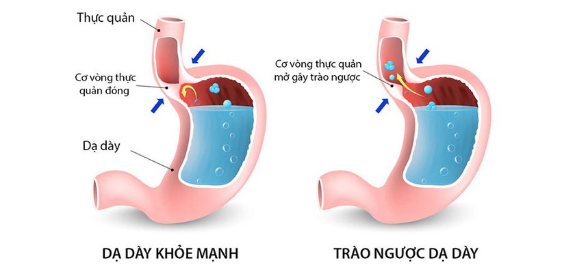 Một số triệu chứng thường gặp của trào ngược dạ dày là: ho kéo dài, đau ngực, đau rát họng…
