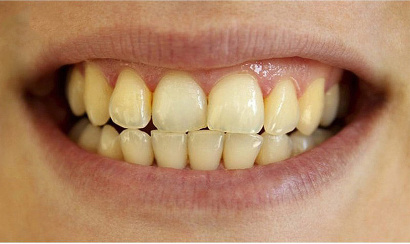 Có cách nào khắc phục răng bị ố vàng lâu năm một cách hiệu quả nhất?