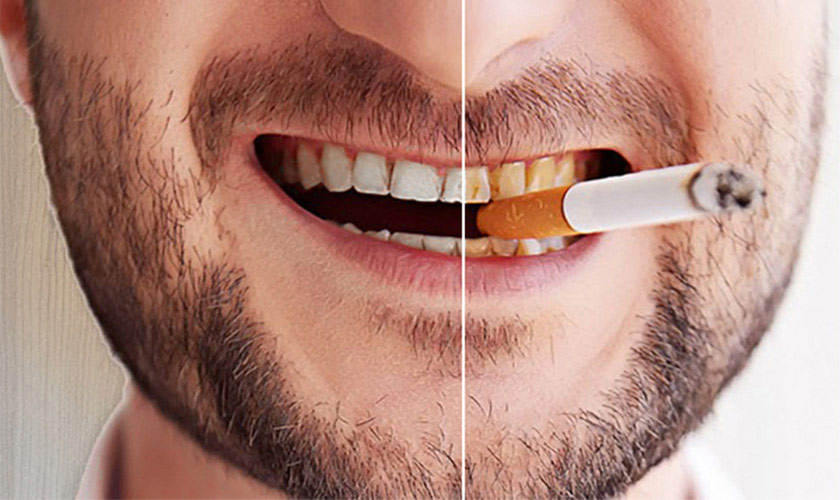 Hút thuốc làm cho răng trở nên ố vàng theo thời gian