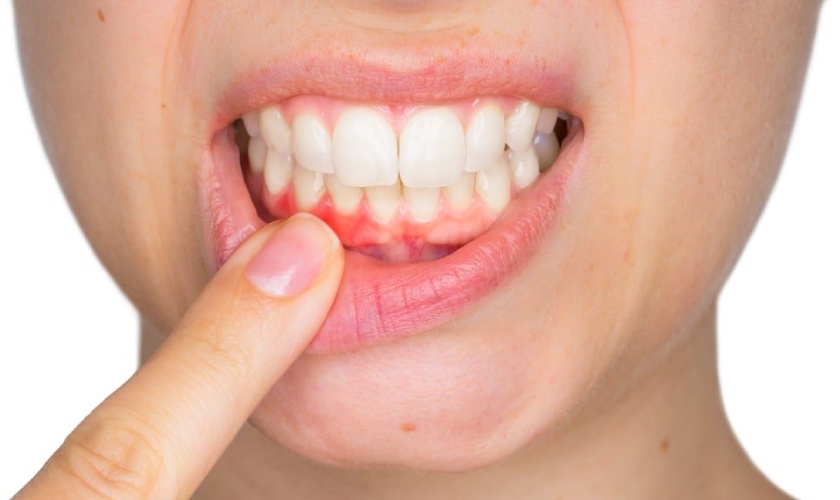 Viêm nha chu có thể gây nguy cơ mất răng cao