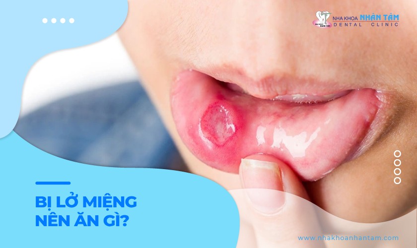 Bị lở miệng nên ăn gì? Bí quyết giúp giảm nhiệt miệng 