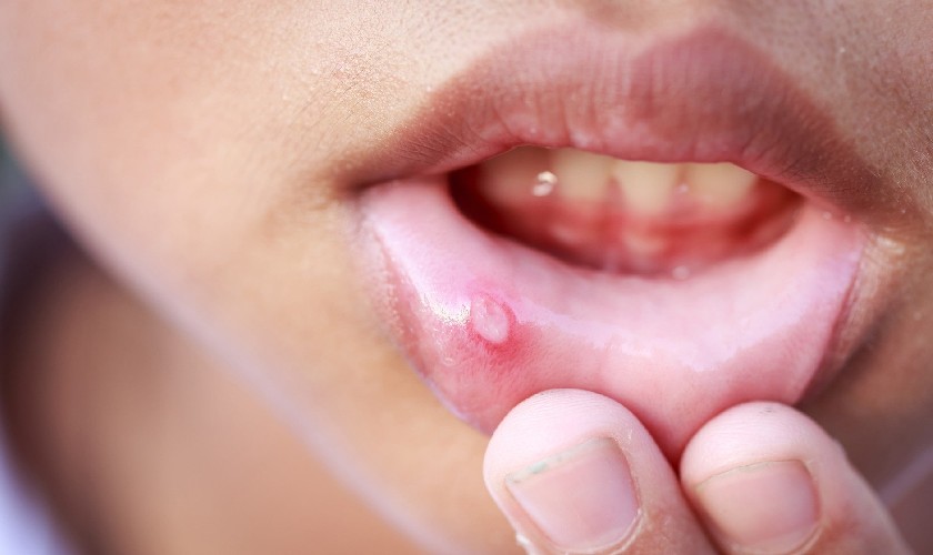 Lở miệng là tình trạng có thể gặp ở bất cứ ai