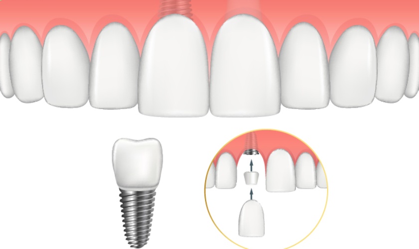 Trồng răng Implant được chỉ định khi răng cửa bị mẻ lớn, không thể hồi phục Trồng răng Implant được chỉ định khi răng cửa bị mẻ lớn, không thể hồi phục
