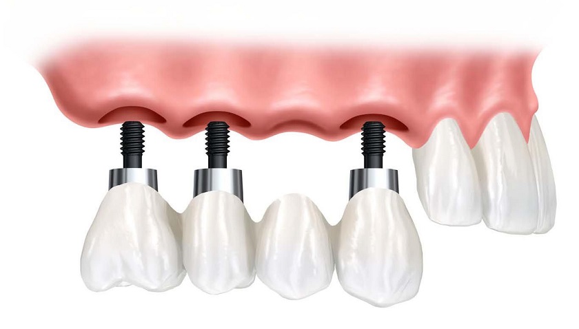 Trồng răng implant giúp phục hình răng hư nặng phải nhổ