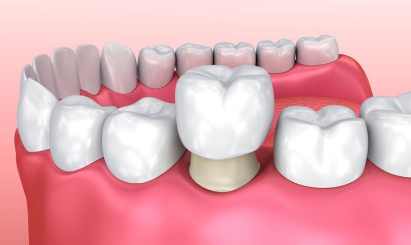Bọc răng sứ cho răng bị gãy vỡ lớn