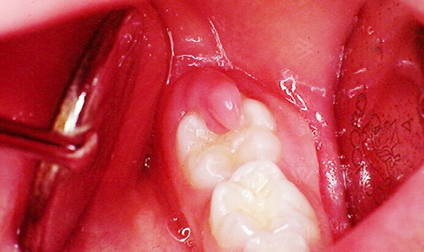 Bật mí cách trị sưng nướu răng trong cùng hàm dưới