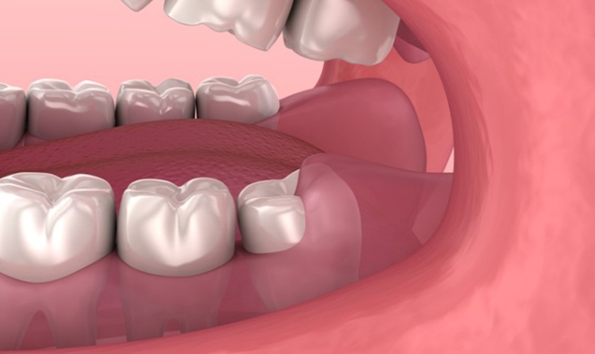 Răng khôn mọc gây sưng nướu răng