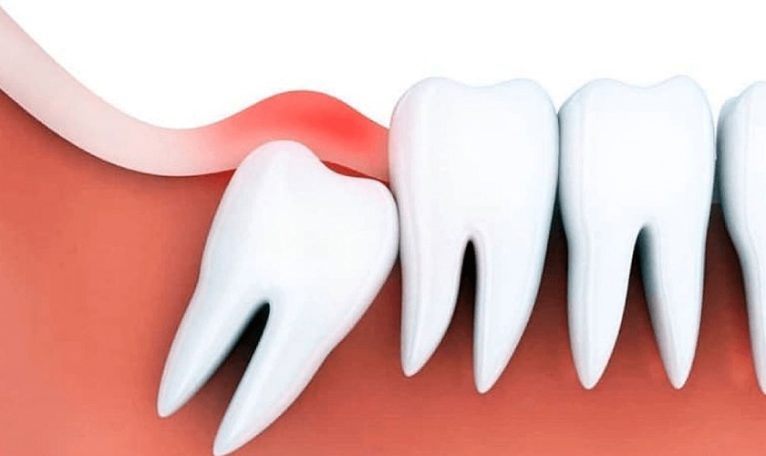 Viêm nướu là nguyên nhân khiến nướu răng trong cùng bị sưng