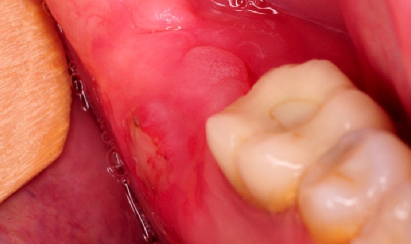 Nướu răng trong cùng bị viêm đỏ