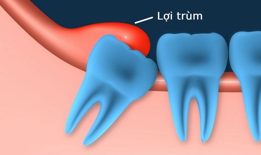 Cắt lợi trùm răng khôn