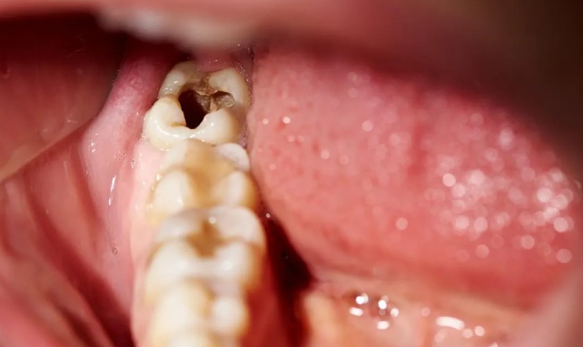 Điều trị sâu răng