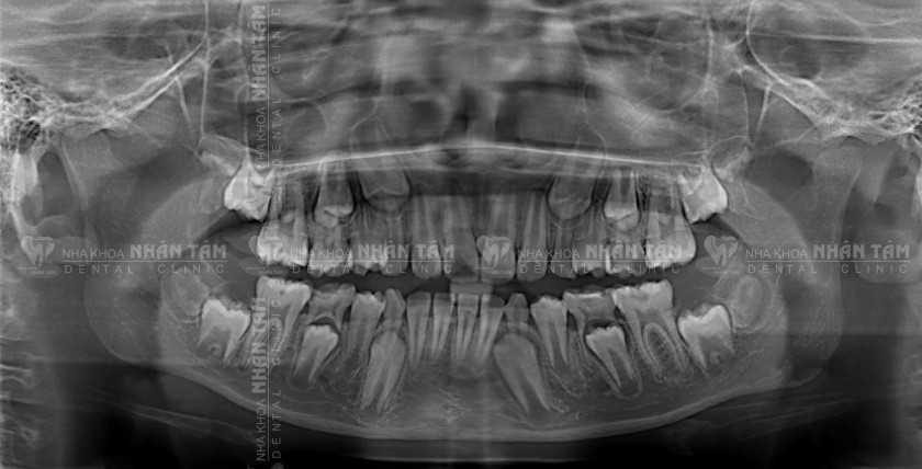 Chụp X-quang mang đến nhiều lợi ích trong nha khoa