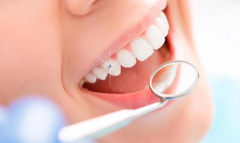 Gắn đá vào răng làm tăng tính thẩm mỹ cho nụ cười