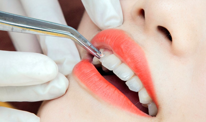 Gắn đá vào răng cần được thực hiện tại địa chỉ nha khoa uy tín