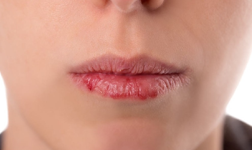 Khô miệng có thể gây đắng miệng