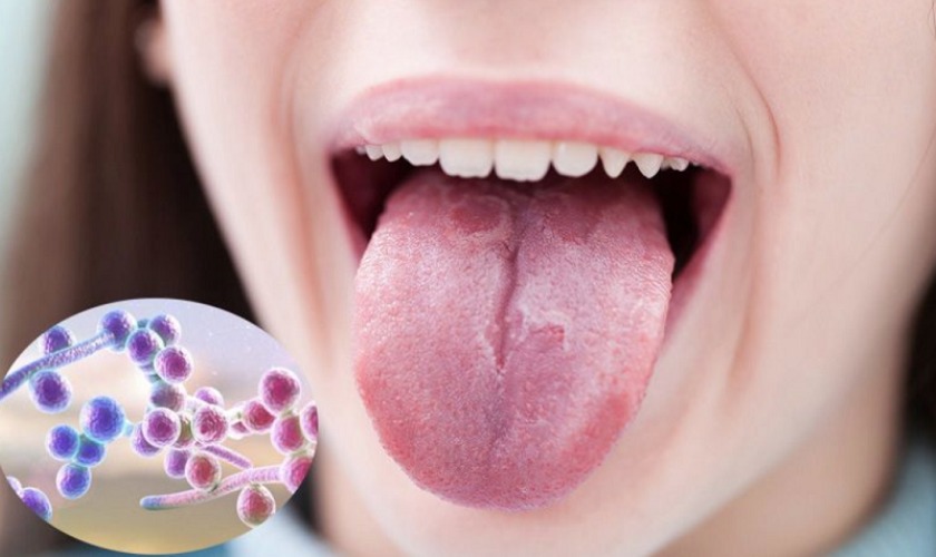 Nấm miệng có thể gây ra vị đắng khó chịu