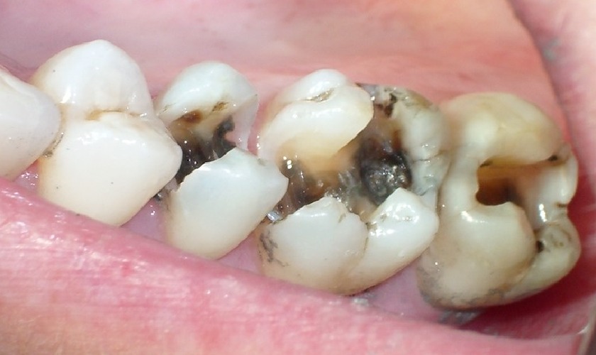 Đắng miệng có thể là dấu hiệu cảnh báo bệnh sâu răng