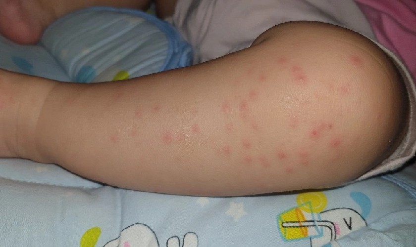 Bệnh tay chân miệng nếu tiến triển nặng sẽ dẫn đến nhiều biến chứng nguy hiểm