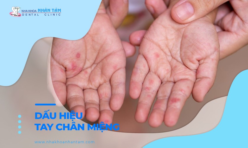Dấu hiệu tay chân miệng dễ nhận biết và cách điều trị