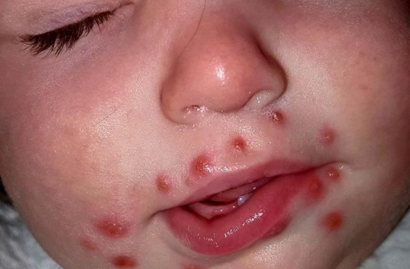 Hình ảnh trẻ bị tay chân miệng kèm theo sốt cao