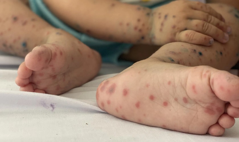 Hình ảnh bệnh tay chân miệng ở giai đoạn phát triển nặng
