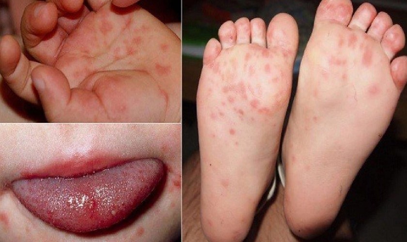 Bệnh tay chân miệng là một bệnh truyền nhiễm cấp tính do virus đường ruột gây ra