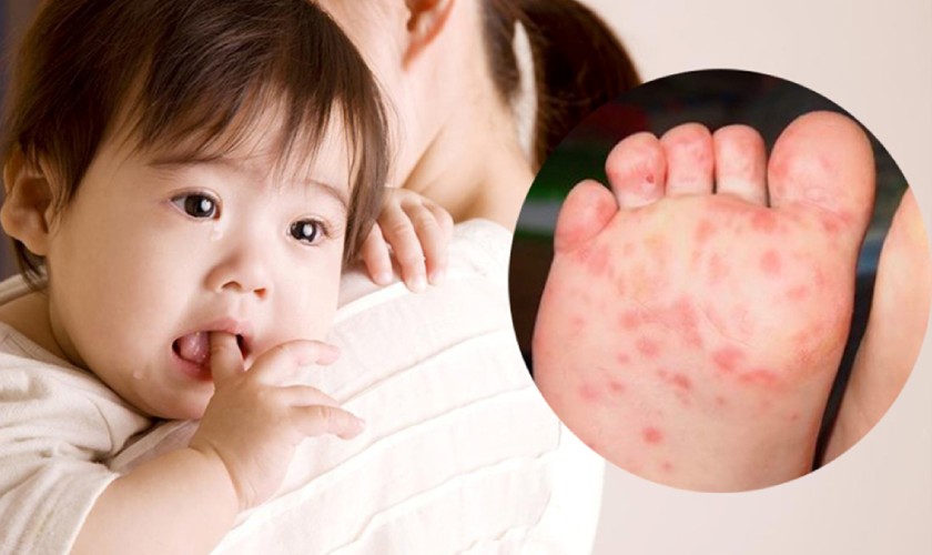 Virus Coxsackievirus A16 và Enterovirus 71 là nguyên nhân chính gây ra bệnh tay chân miệng