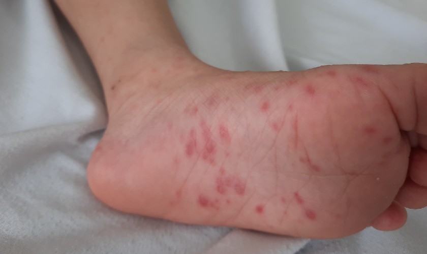 Dấu hiệu bệnh tay chân miệng