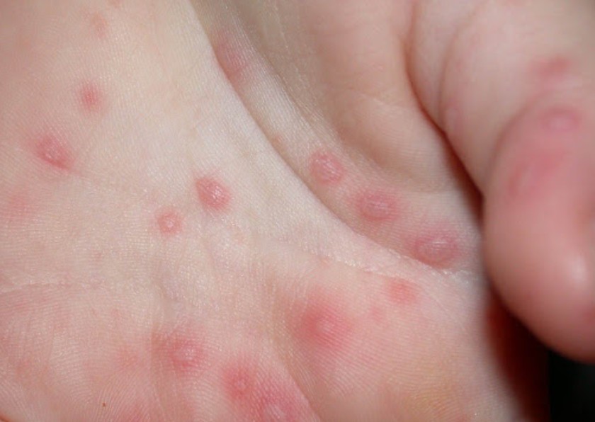 Hình ảnh nốt mụn tay chân miệng ở trẻ