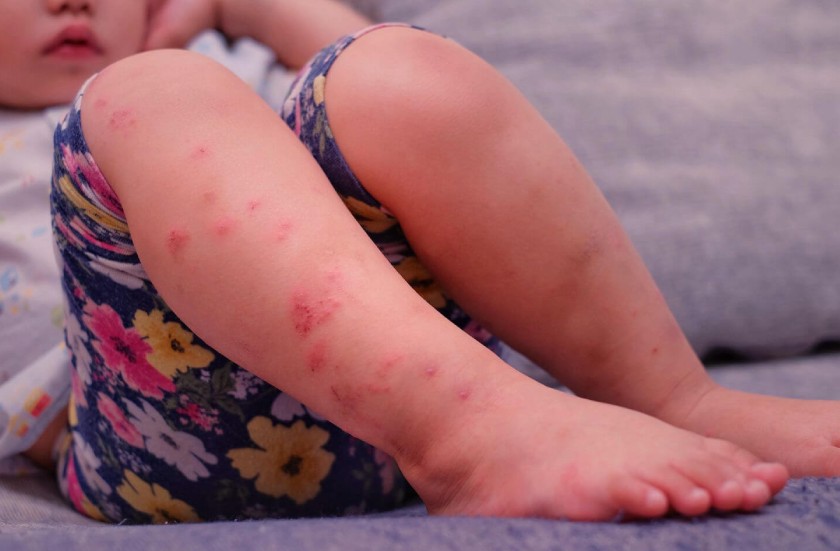 Trẻ bị tay chân miệng xuất hiện nhiều mụn nước trên cơ thể