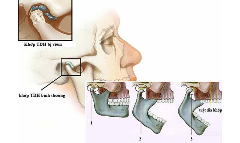 Bệnh viêm khớp thái dương hàm
