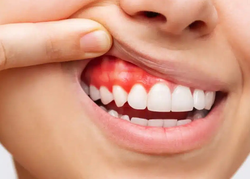 Đau quai hàm có thể do bệnh lý về răng miệng