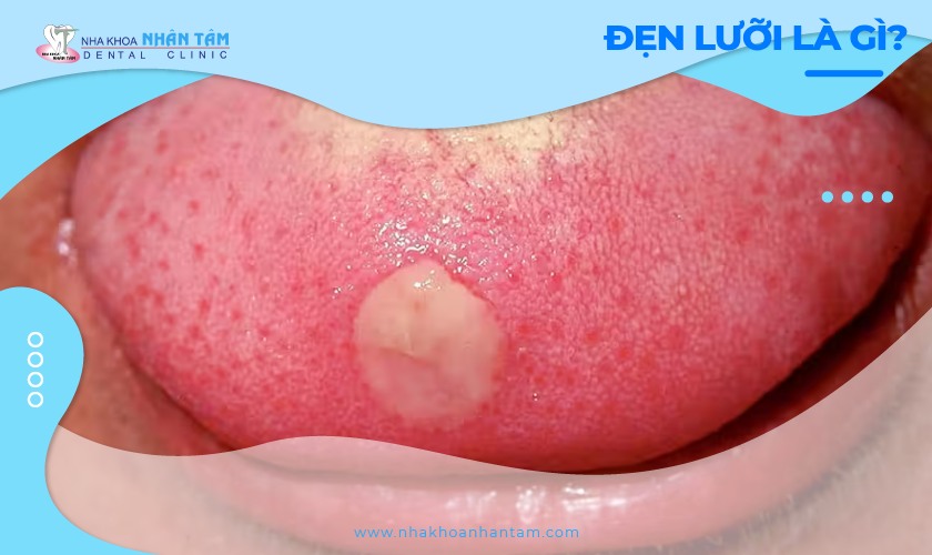 Đẹn lưỡi là gì? Mẹo chữa đẹn lưỡi tại nhà