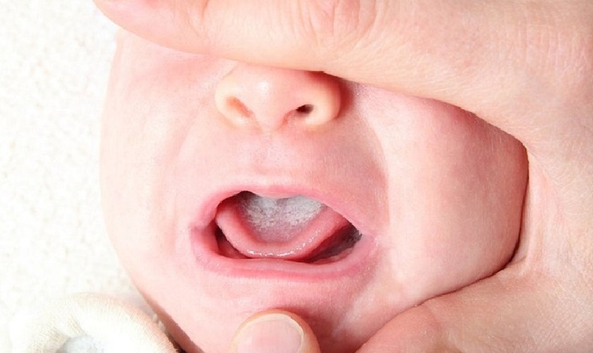 Đẹn lưỡi thường xuất hiện ở trẻ nhỏ