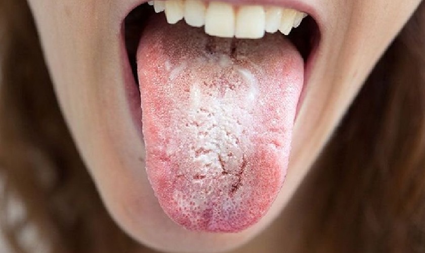 Dấu hiệu bị nổi đẹn trong miệng