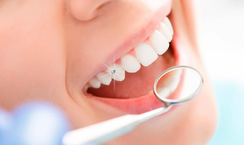 Đính đá lên răng là gì? Những thông tin cần biết 