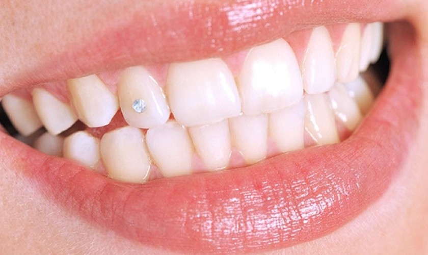 Đính đá lên răng là dịch vụ được rất nhiều người ưa chuộng