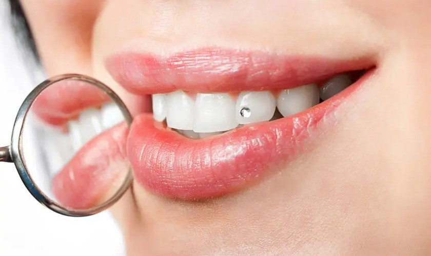 Đính đá lên răng mang đến nụ cười tỏa nắng