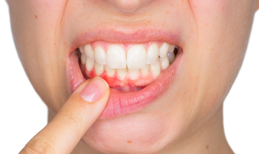 Viêm nướu là nguyên nhân khiến răng bị ê buốt