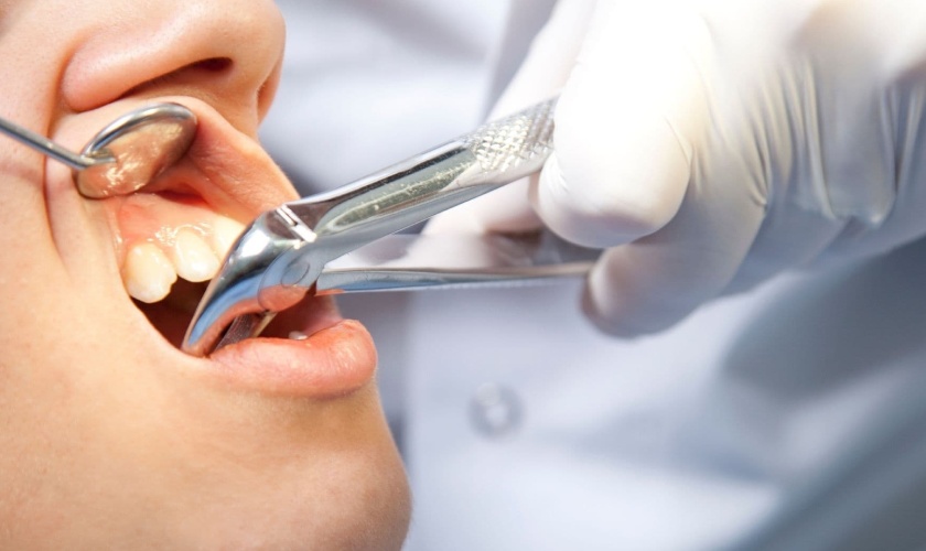 Nhổ răng là biện pháp cuối cùng khi không thể giữ răng lại được nữa