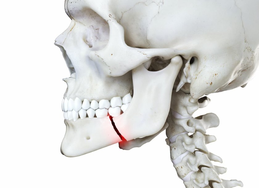 Gãy xương hàm gây ra nhiều phiền toái cho bệnh nhân