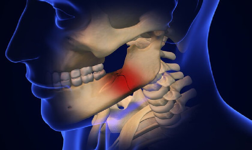 Khi xương hàm bị gãy, bệnh nhân thường cảm thấy đau đớn