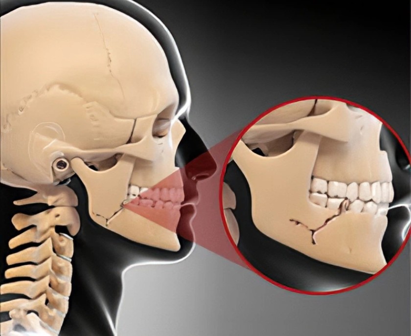 Gãy xương hàm có thể nguy hiểm nếu không được điều trị đúng cách và kịp thời