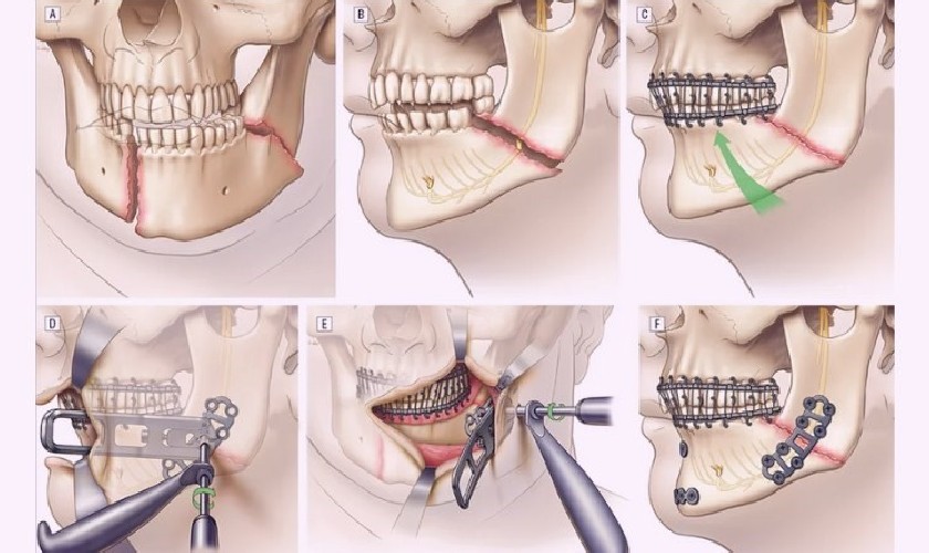 Phương pháp điều trị gãy xương hàm