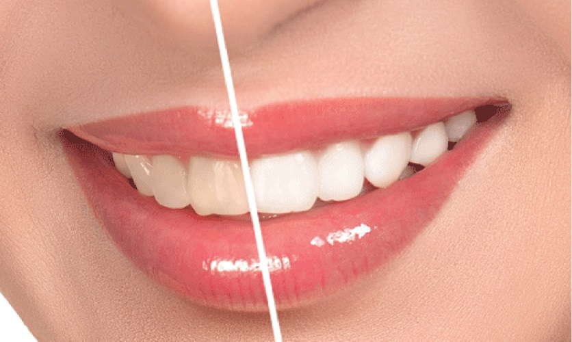 Tẩy răng ố vàng giá bao nhiêu? Bảng giá tẩy trắng răng mới