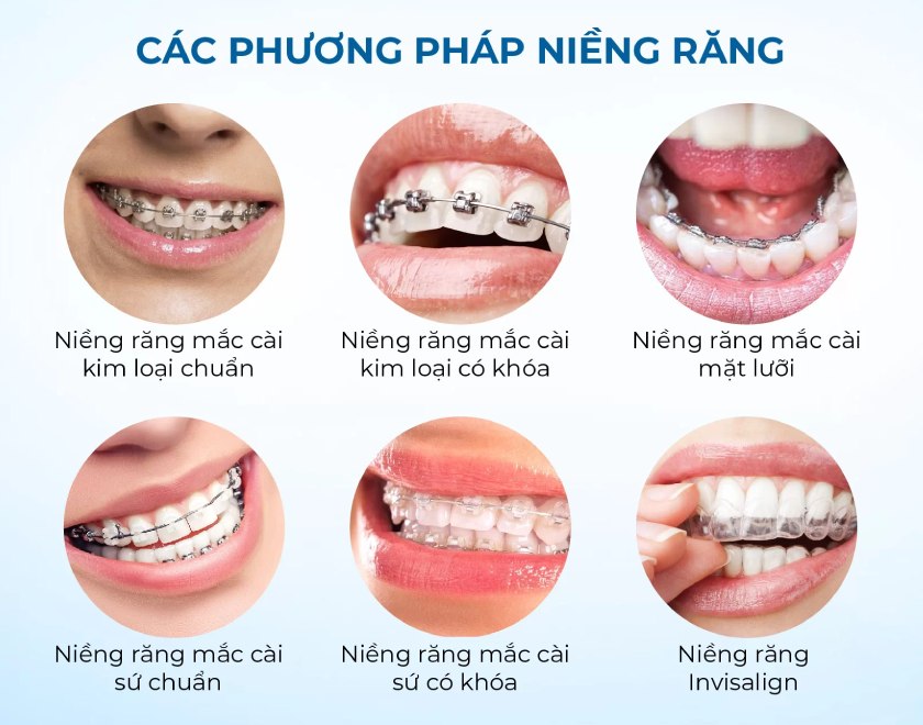 Các giải pháp niềng răng hiện nay