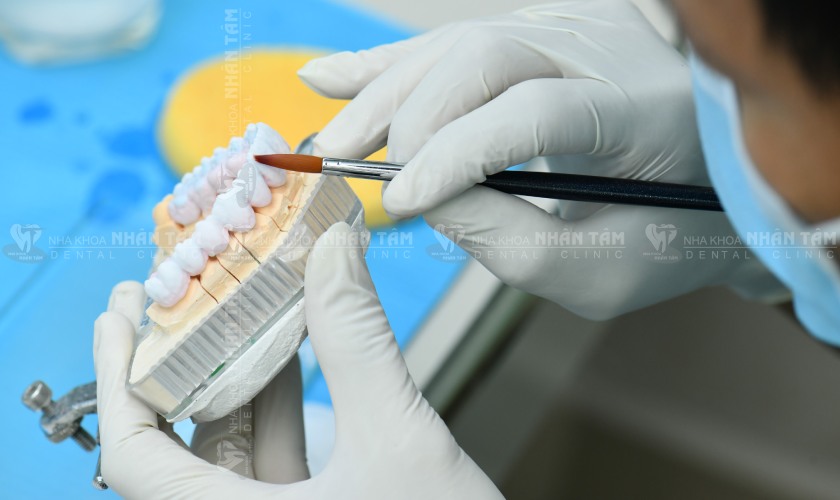 Kỹ thuật bọc răng sứ