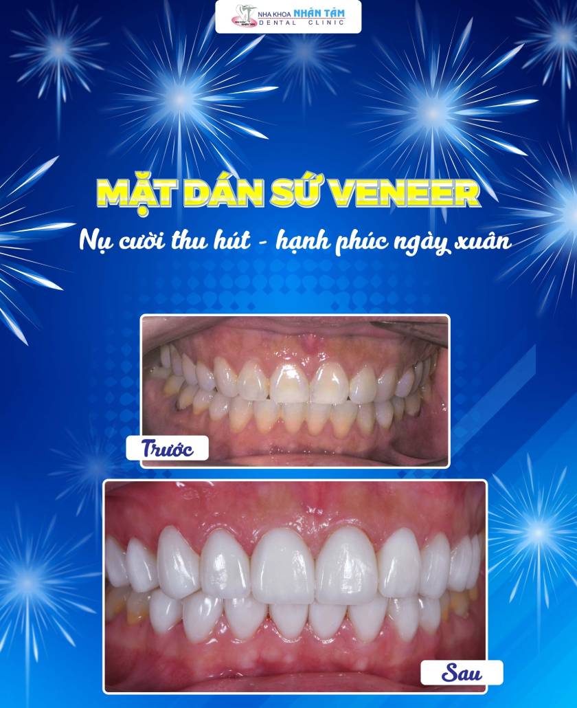 Nụ cười hoàn hảo sau khi dán sứ Veneer