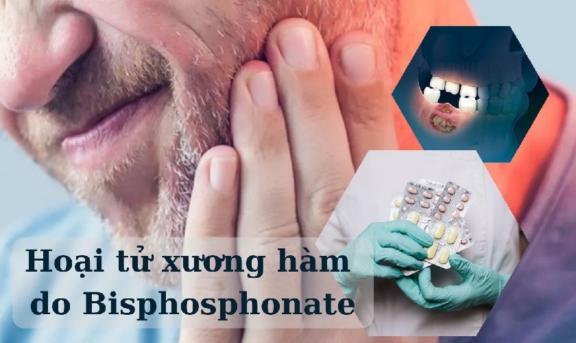 Thuốc Bisphosphonate có tác dụng phụ là hạn chế quá trình tạo mao mạch trong xương và giảm khả năng tự hồi phục của xương Thuốc Bisphosphonate có tác dụng phụ là hạn chế quá trình tạo mao mạch trong xương và giảm khả năng tự hồi phục của xương
