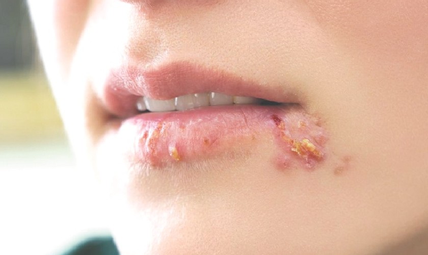 Mụn rộp sinh dục là một bệnh lý xã hội